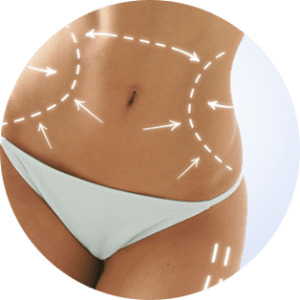 Abdominoplastie abdomen graisseux