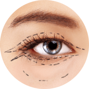 Blépharoplastie