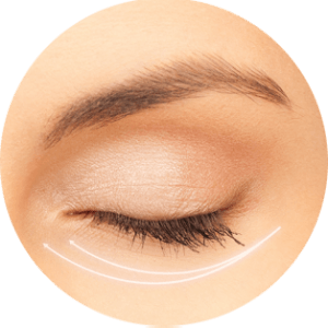 Blépharoplastie inférieure
